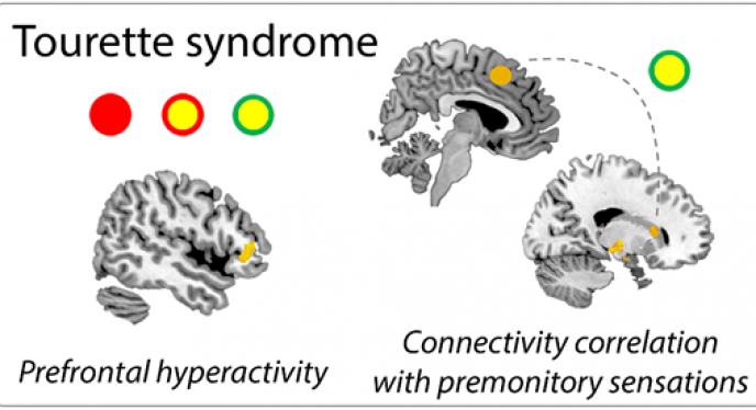 Research study explains the brain basis for feeling tired after tic suppression